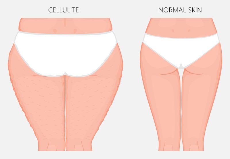 Vector illustration of cellulite treatment before and after.
