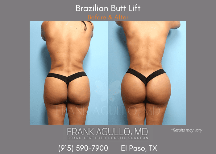 Before and after image showing the results of a Brazilian Butt Lift performed in El Paso.