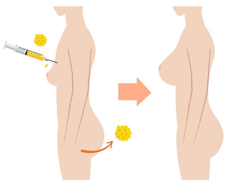 Illustration demonstrating fat injections in the body.