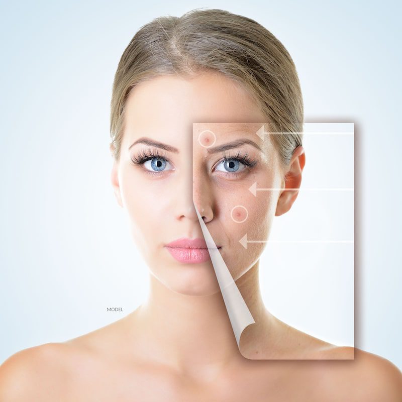 Woman's face with overlay of image highlighting acne.