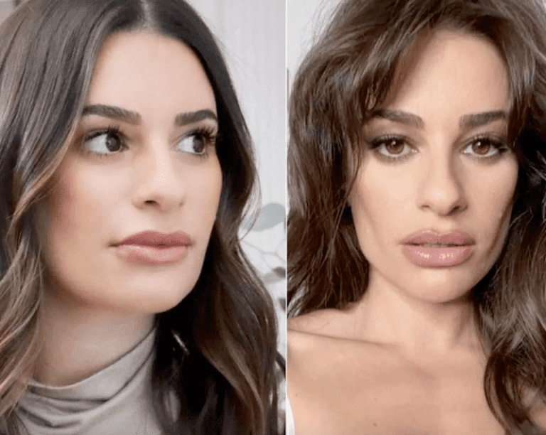 BUCCAL FAT PAD REMOVAL TRENDING AMONG CELEBRITIES Frank Agullo, MD