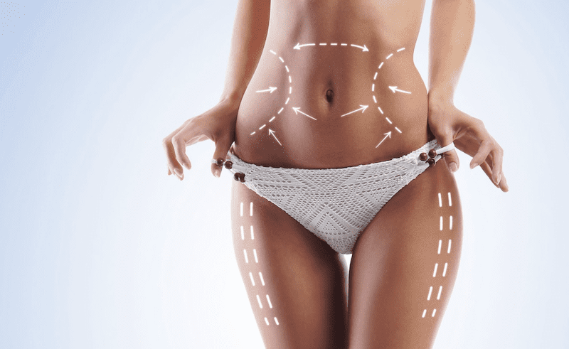 THE STATS ARE IN! LIPOSUCTION HAS BECOME THE MOST POPULAR PROCEDURE