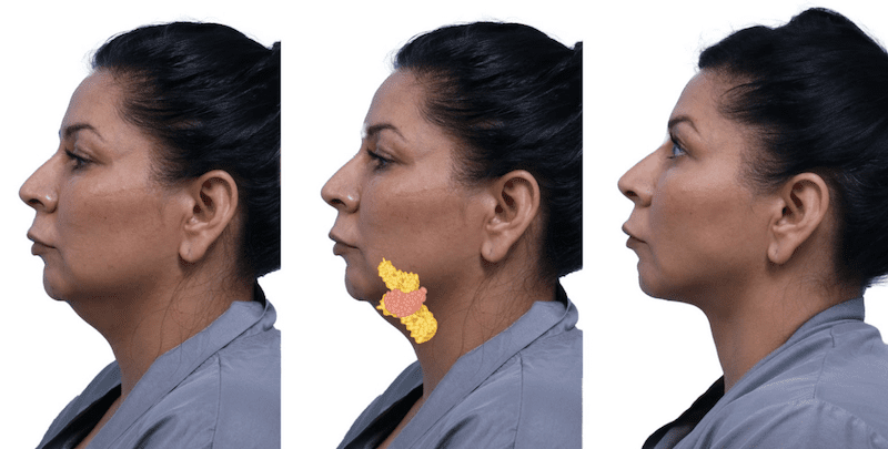 DEEP NECK LIFT & LOWER FACELIFT - Frank Agullo, MD