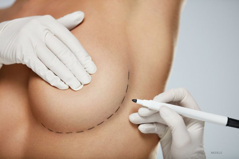 Plastic surgeon drawing lines beneath a breast.