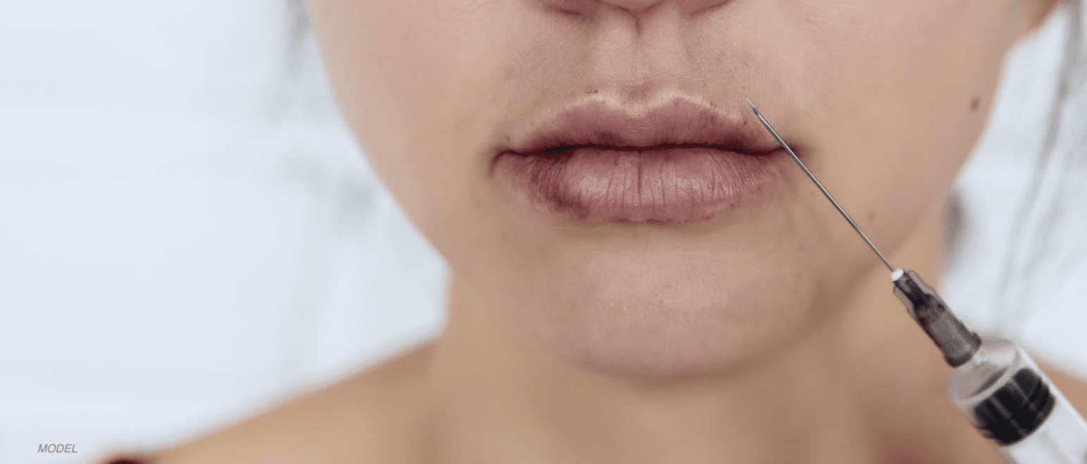 Woman after a lip injection treatment.