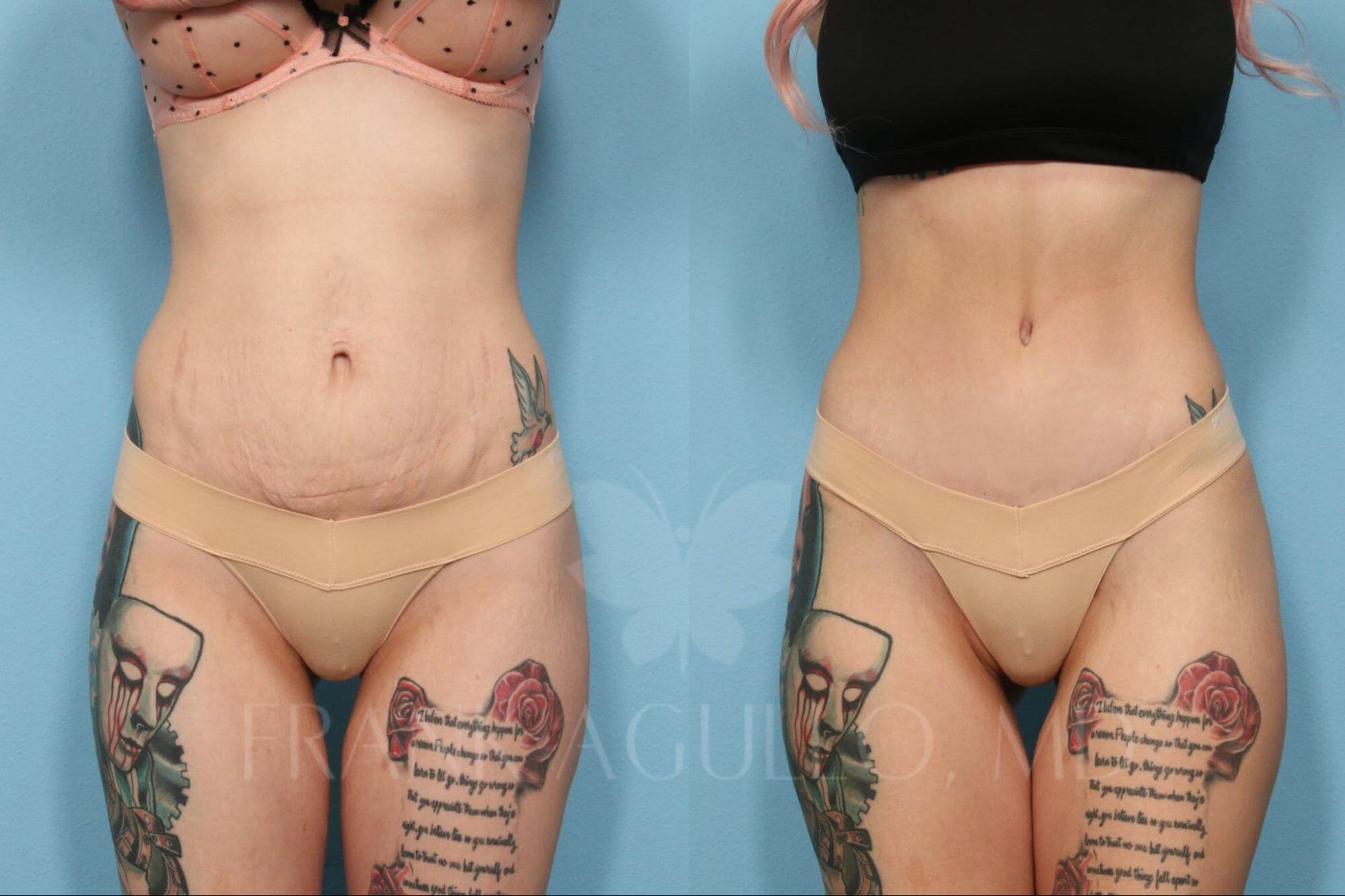 Tummy Tuck: Purpose, Procedure, Before and After Photos, and More