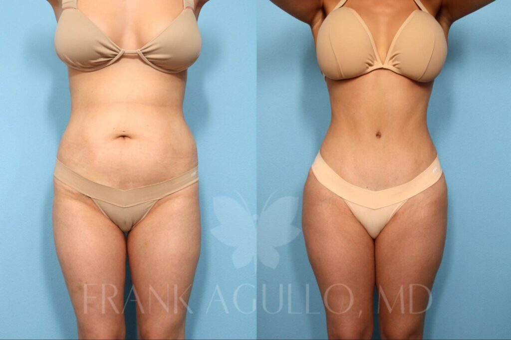 Skinny Tummy Tuck Patient 1