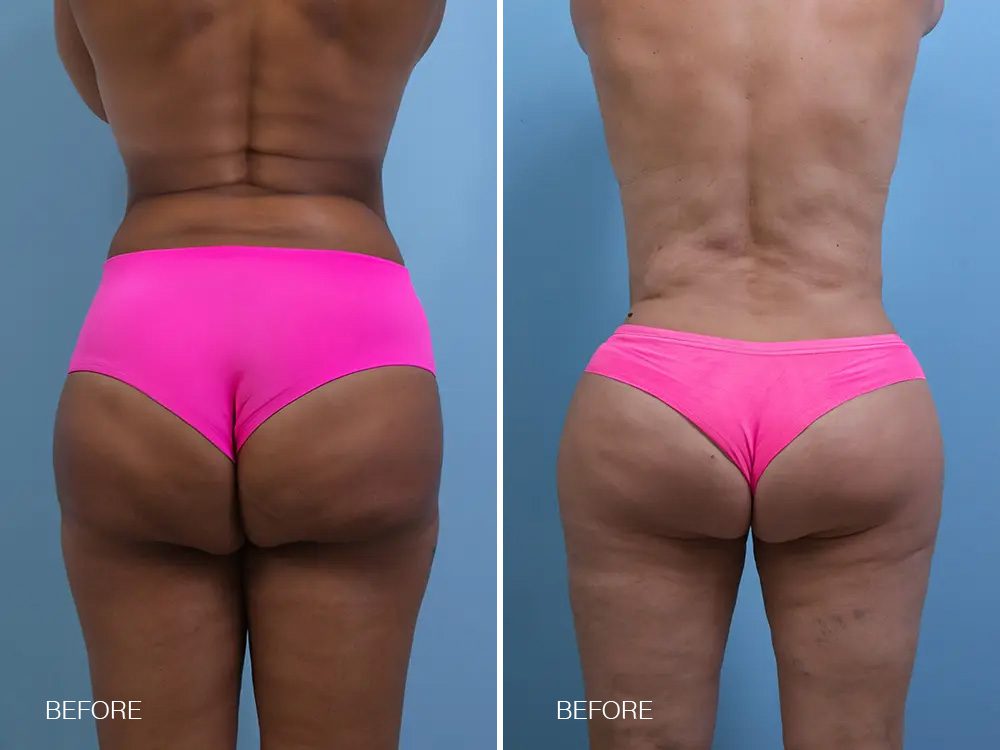 Double Butt Deformity Examples 1 & 2