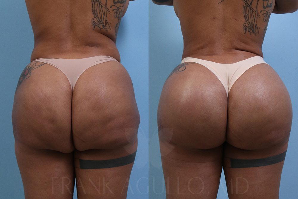 Miami Thong Lift Results