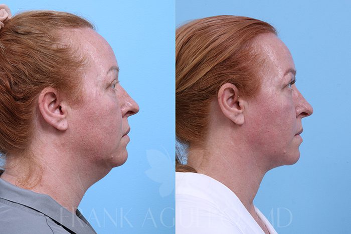 lipo-facetite-neck
