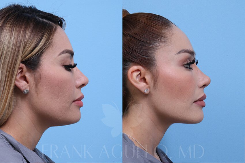 Rhinoplasty