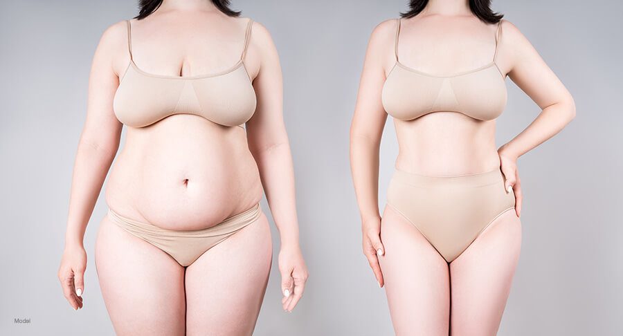 DEMYSTIFYING LIPOSUCTION: UNDERSTANDING THE JARGON IN COSMETIC SURGERY