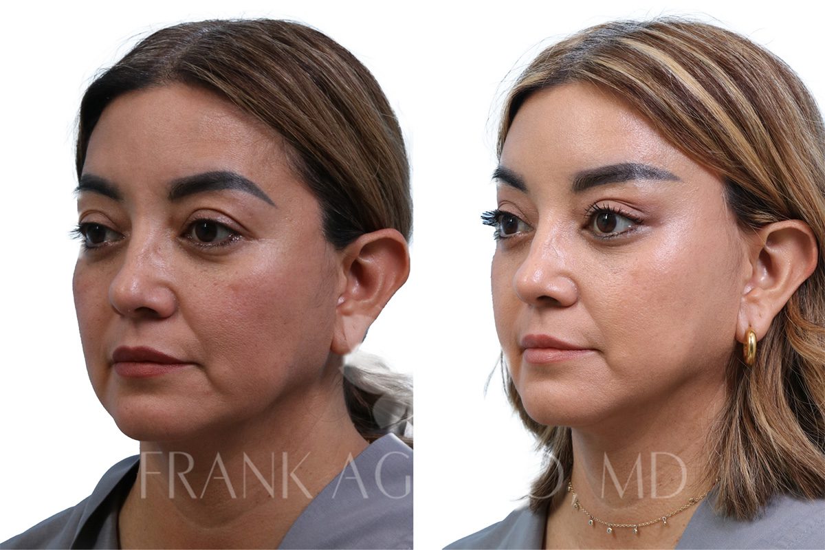 Before and after results