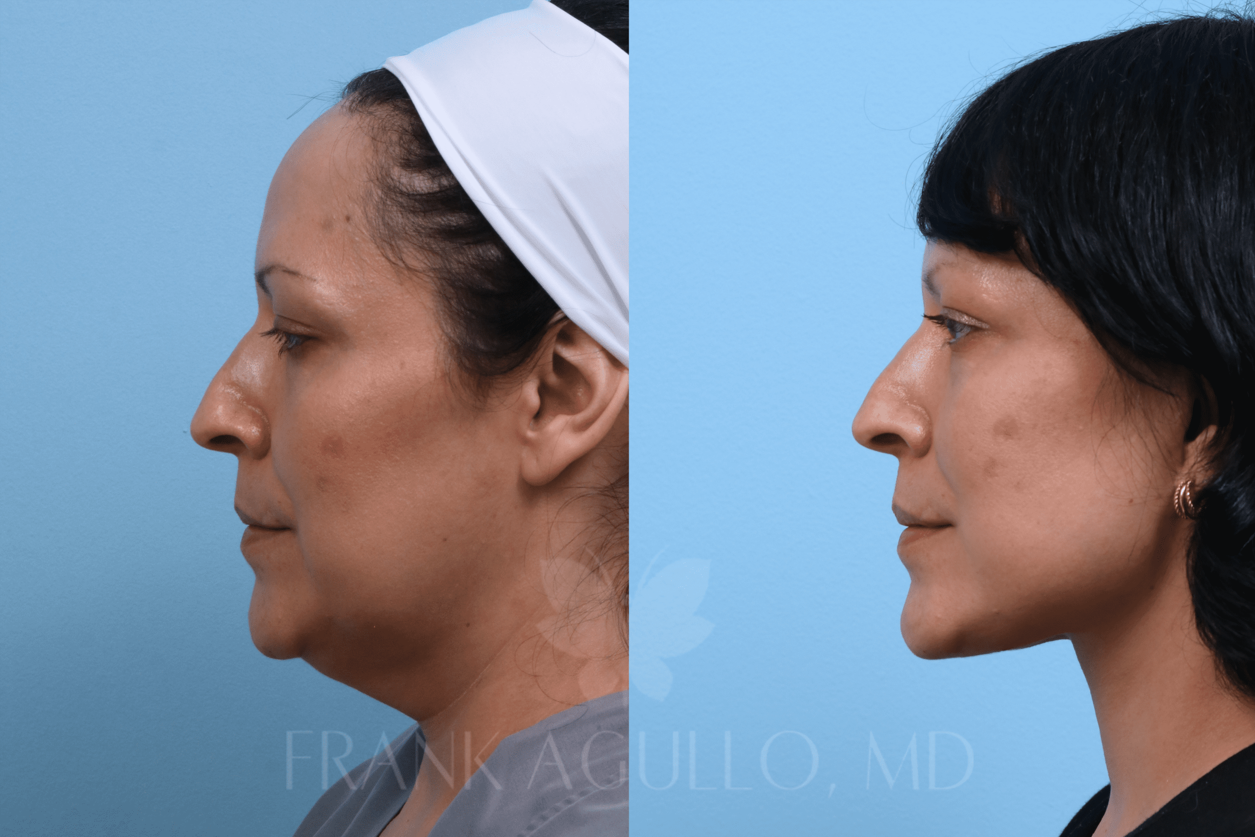 Left profile before and after a Deep Plane Facelift by Dr. Frank Agullo in El Paso, showing a sharper jawline and restored neck contour