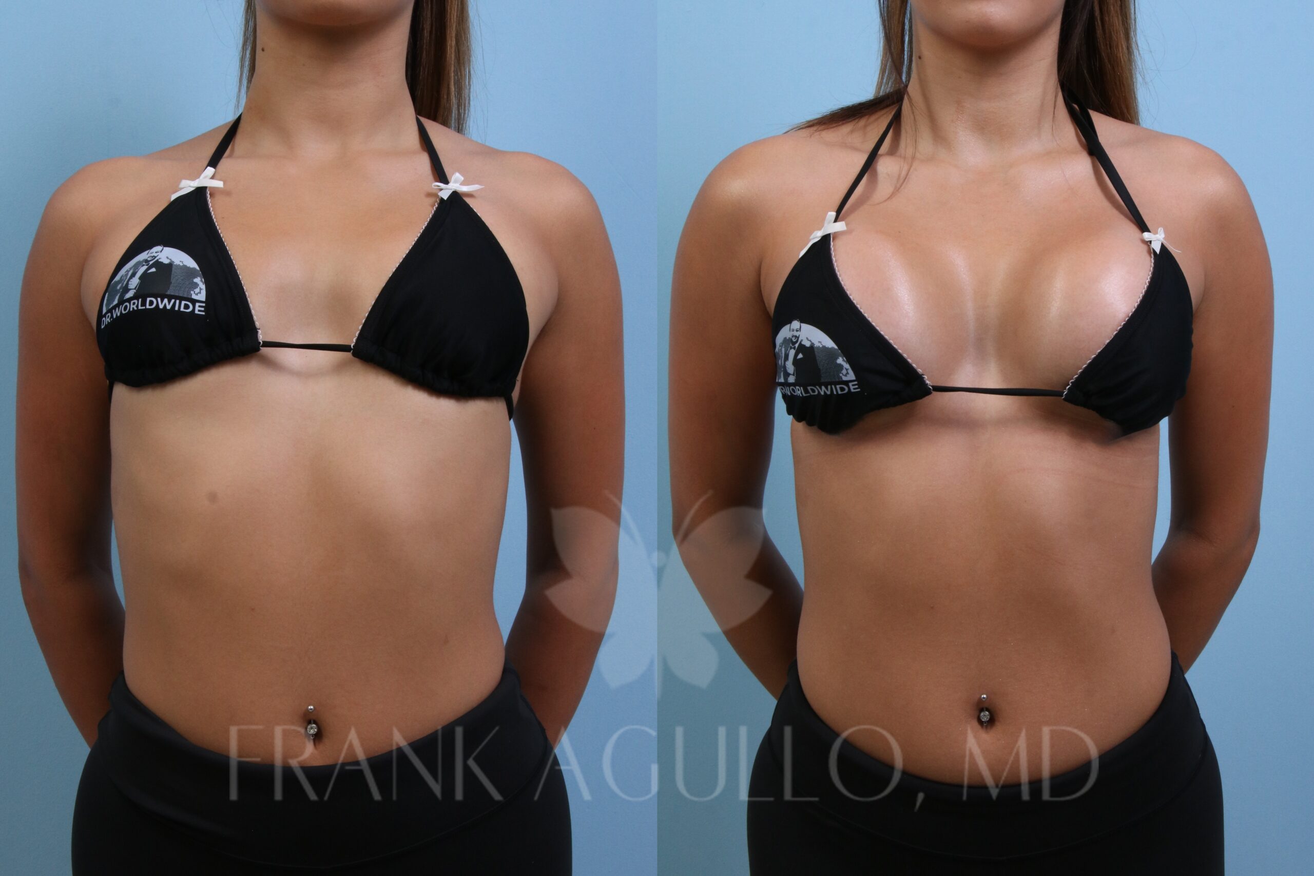 Editorial frontal before and after view of a Motiva Preservé breast augmentation with 315cc Motiva Ergonomix Full implants on a slim athletic young woman patient wearing a Dr. Worldwide bikini, performed by Dr. Frank Agullo, MD, FACS, double board-certified plastic surgeon at Southwest Plastic Surgery in El Paso, Texas.