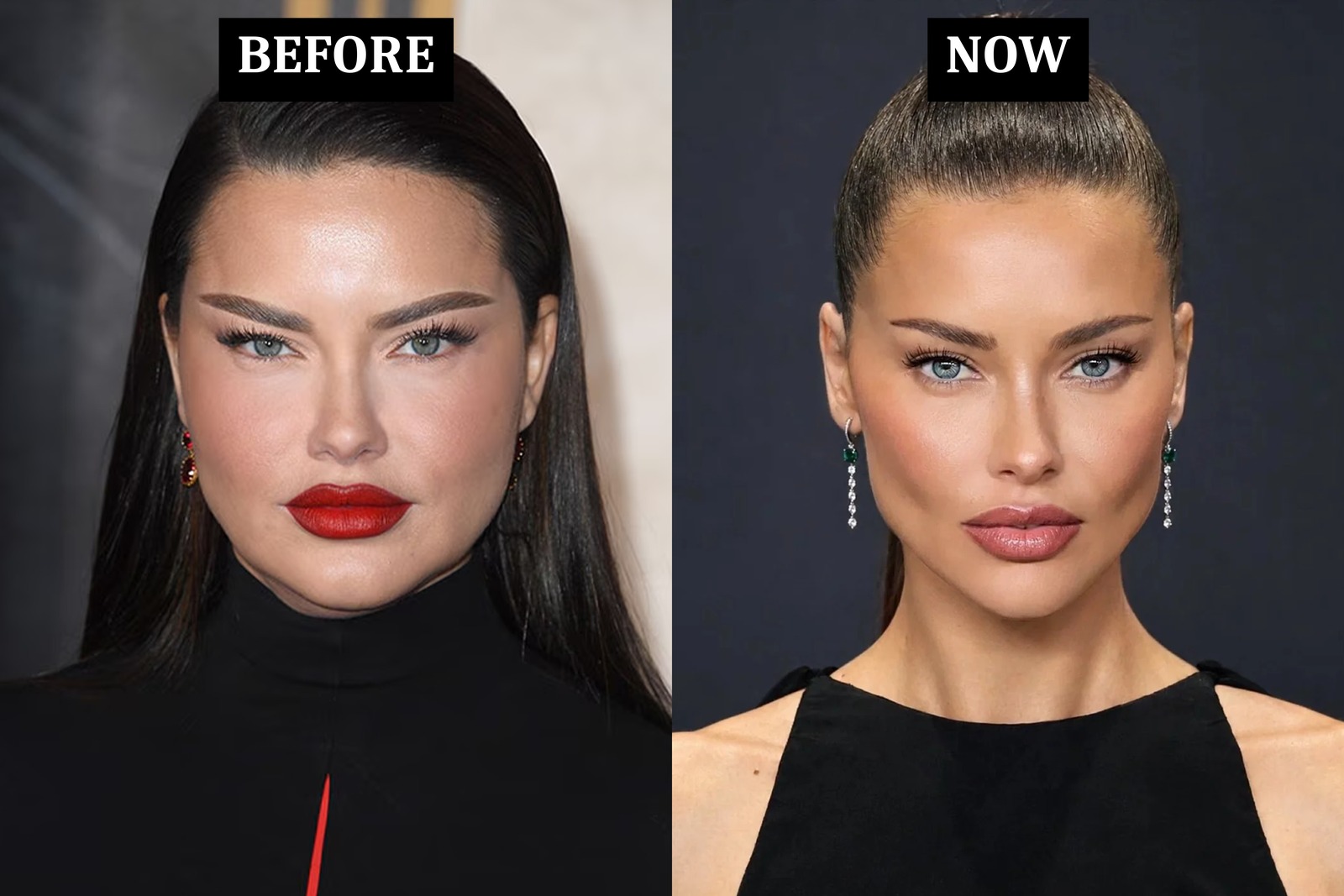 Surgery or Weight Loss? The Adriana Lima Test I Use in Every Consult