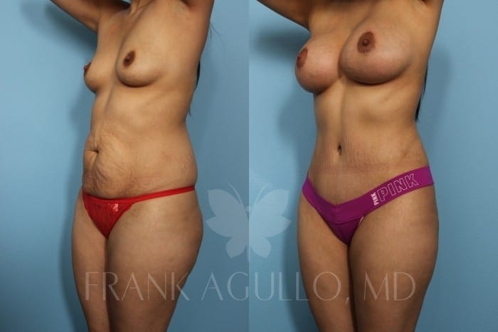 Breast Augmentation Before and After 10