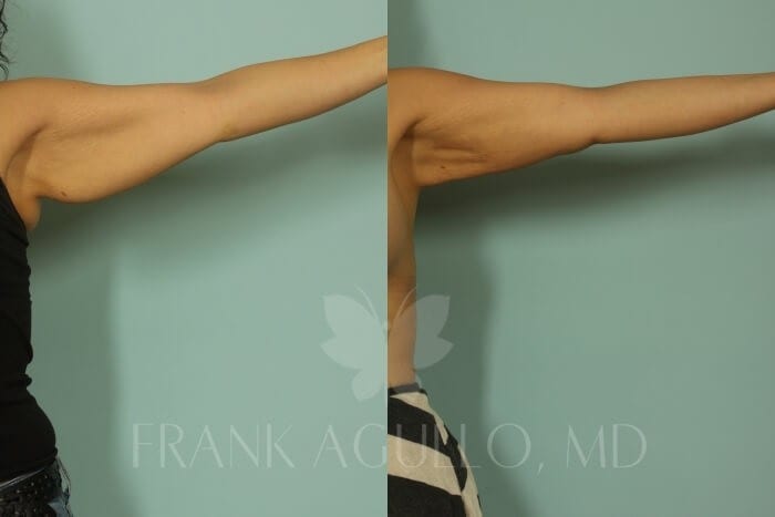 Arm Lift Before and After 10