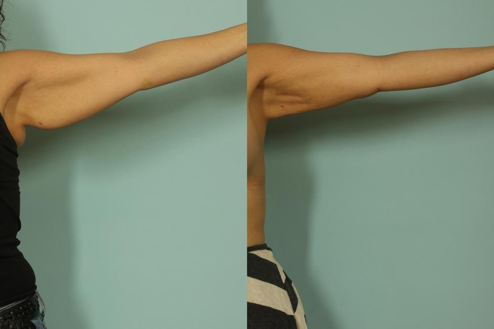 Arm Lift Before and After 2