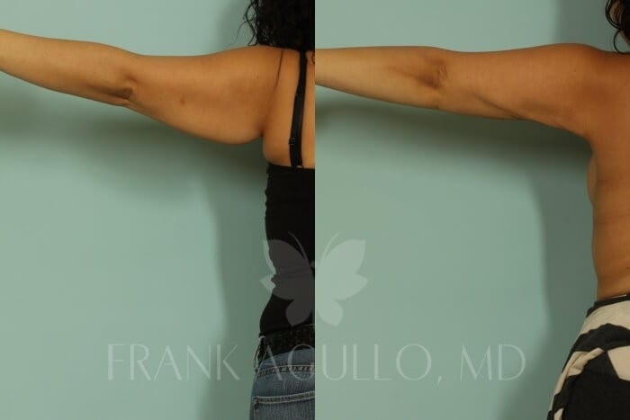 Arm Lift Before and After 3