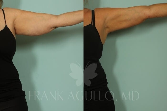 Arm Lift Before and After 9