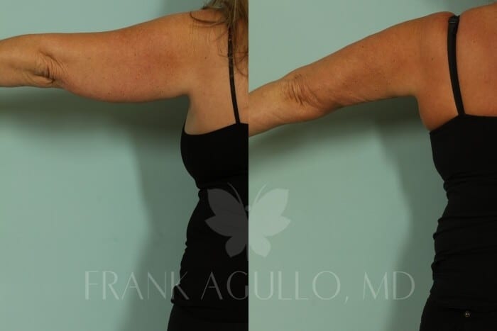 Arm Lift Before and After 5