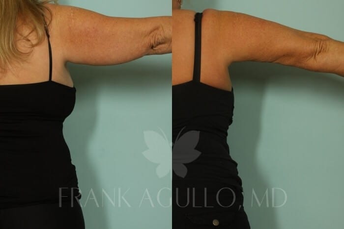 Arm Lift Before and After 7