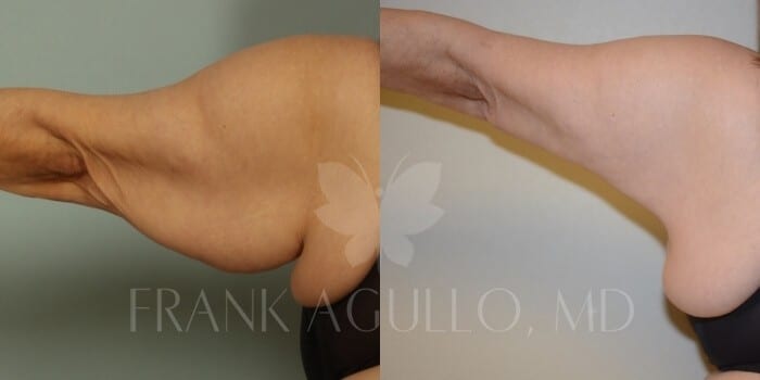 Arm Lift Before and After 2