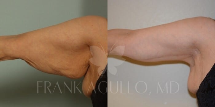 Arm Lift Before and After 3