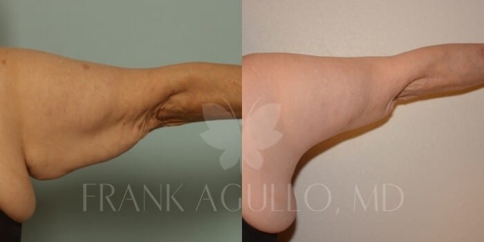 Arm Lift Before and After 4