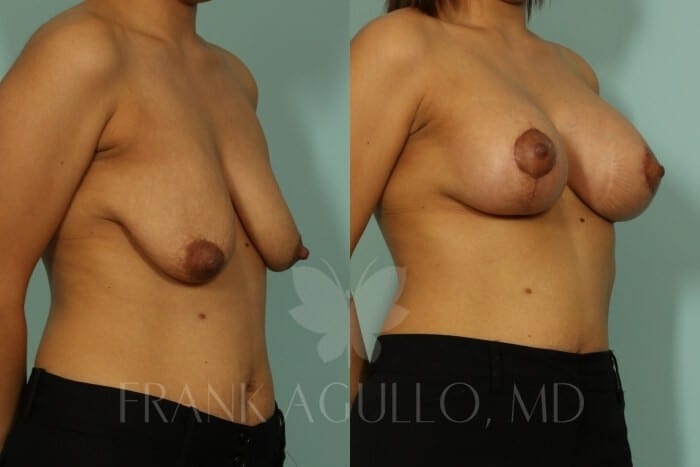 Breast Before and After 3