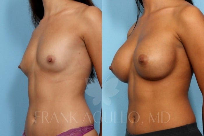 Breast Augmentation Before and After 9
