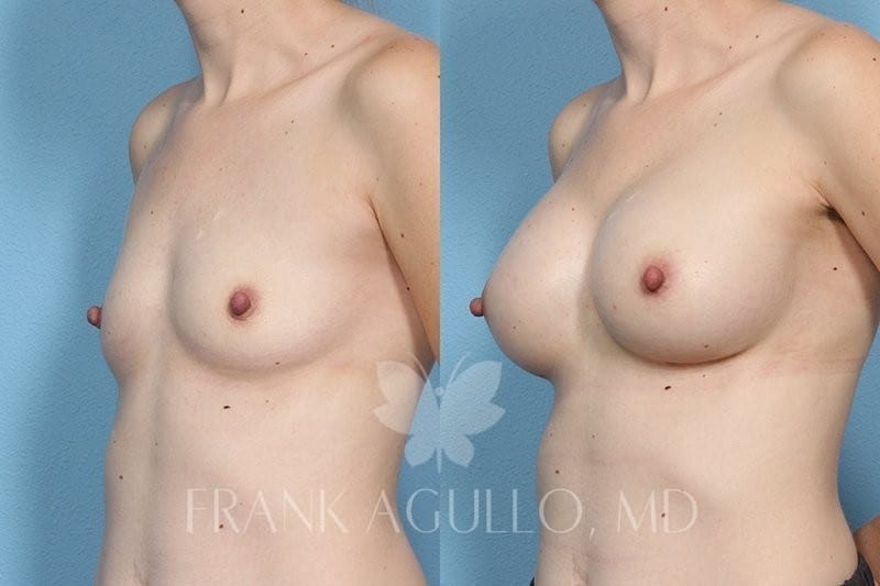 Breast Augmentation Before and After 5