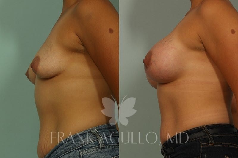 Breast Augmentation Before and After 3