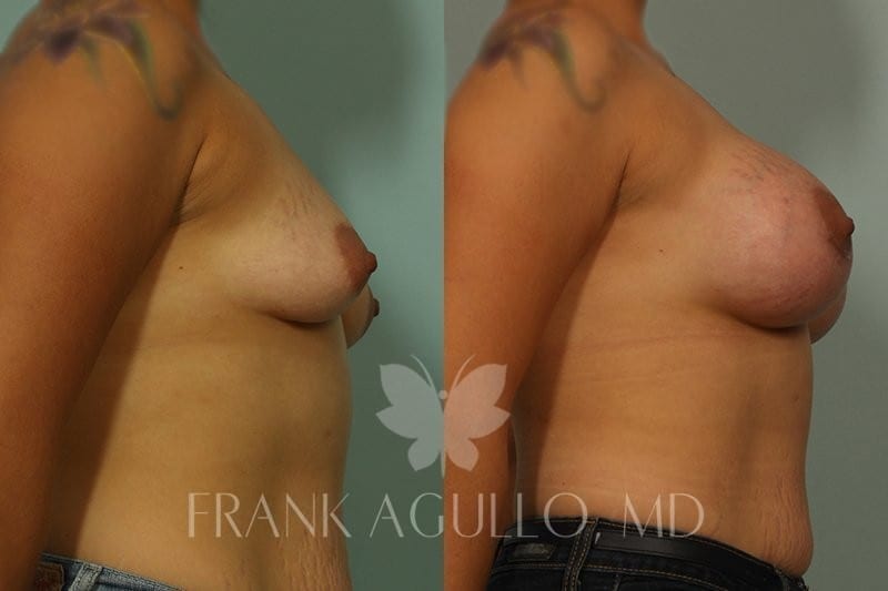 Breast Augmentation Before and After 5