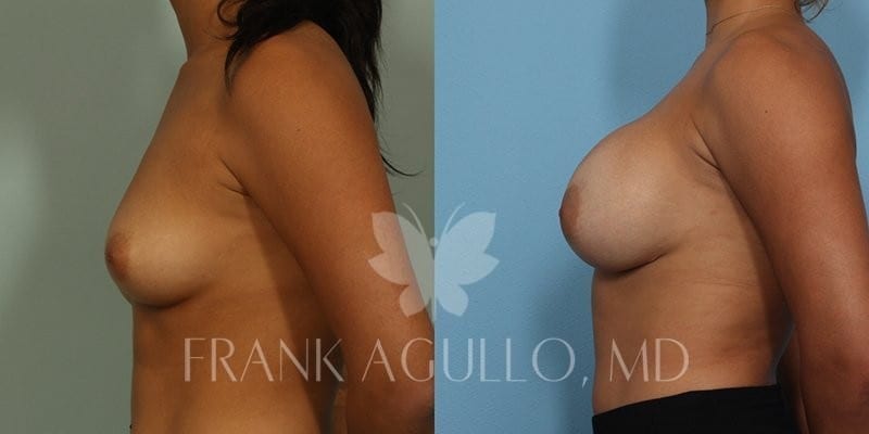 Breast Augmentation Before and After 17