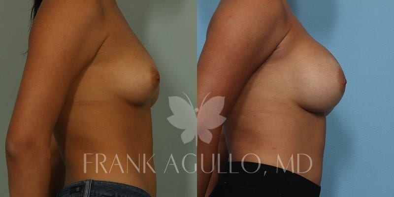 Breast Augmentation Before and After 2