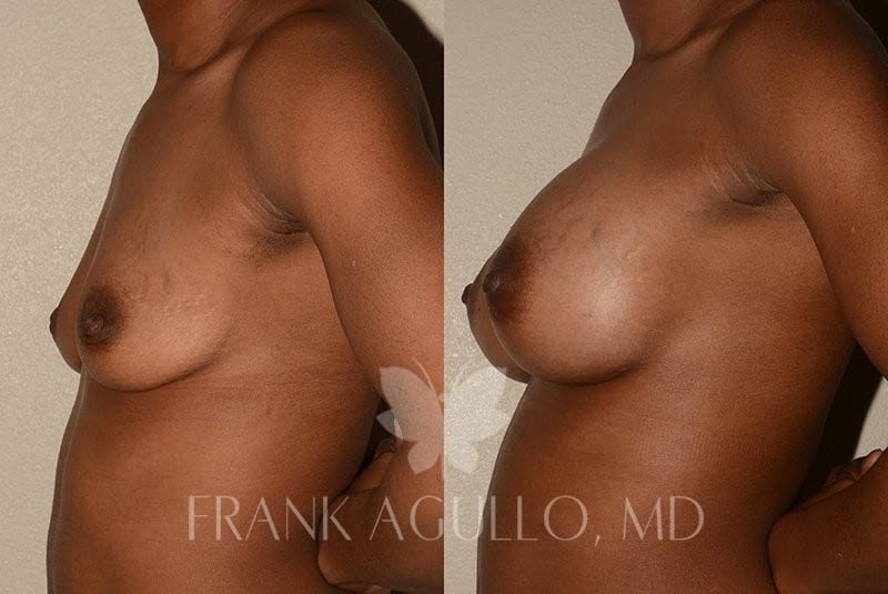 Breast Augmentation Before and After 3
