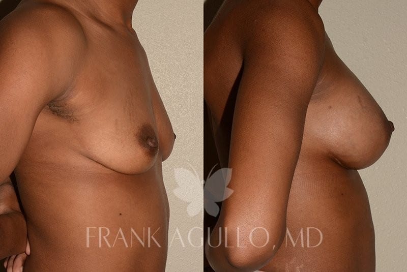 Breast Before and After 6