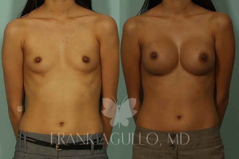 Breast Augmentation Before and After 14