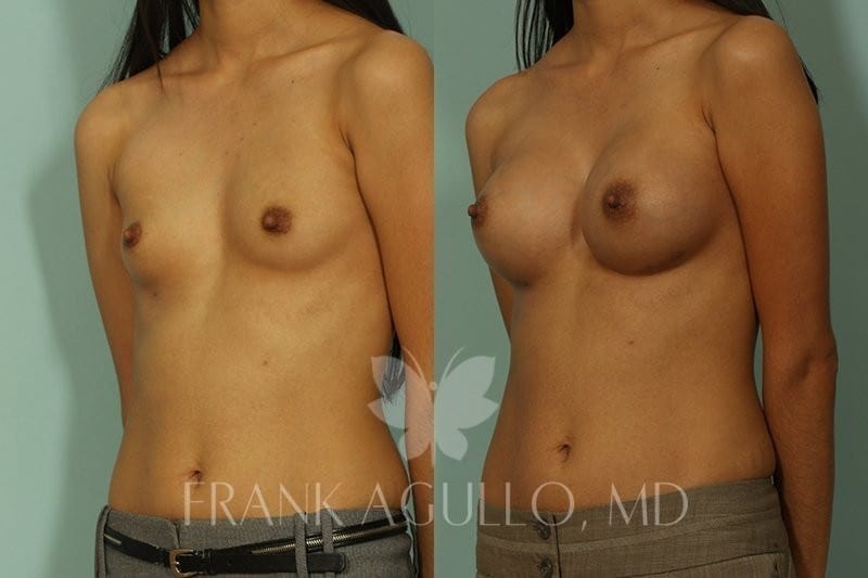 Breast Augmentation Before and After 2