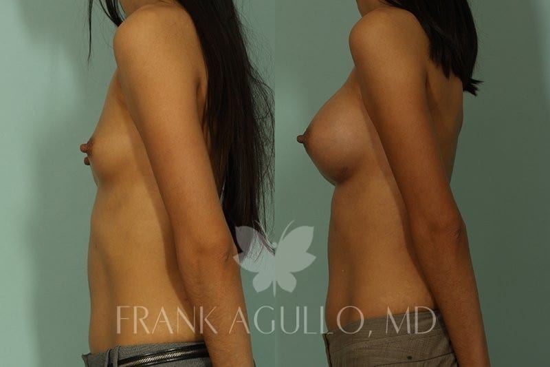 Breast Augmentation Before and After 3