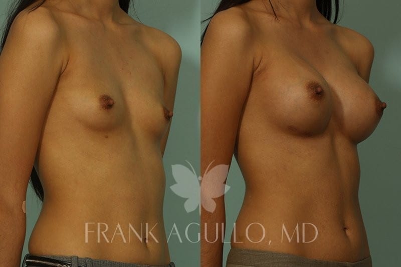 Breast Augmentation Before and After 4