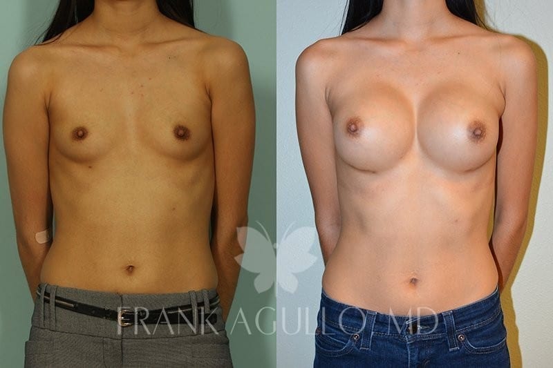Breast Augmentation Before and After 6