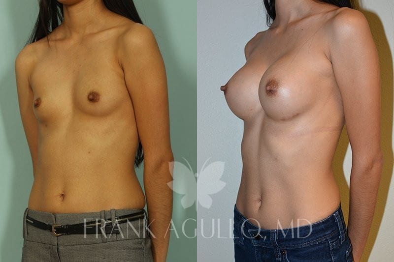 Breast Augmentation Before and After 7