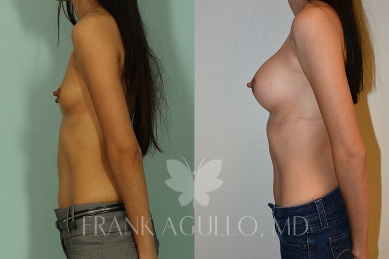 Breast Augmentation Before and After 8