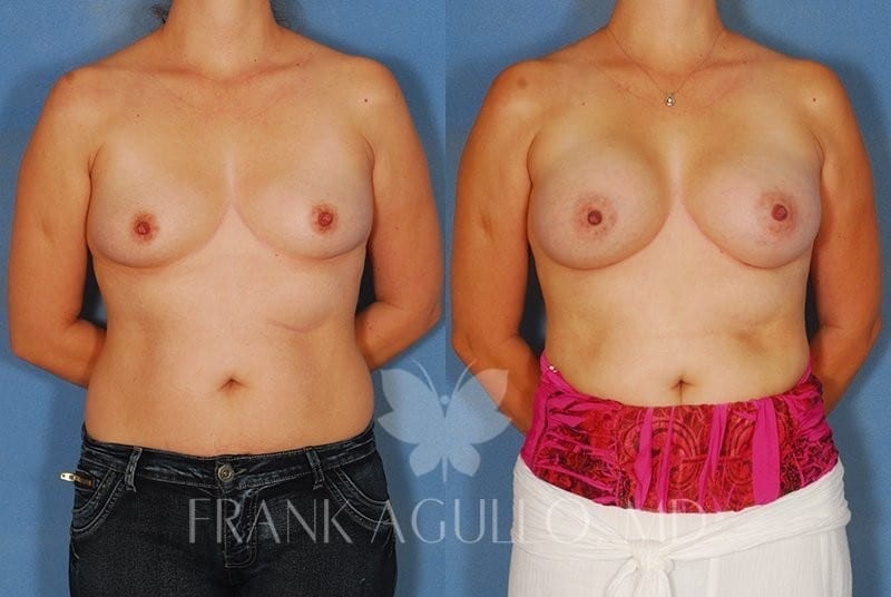 Breast Augmentation Before and After 13