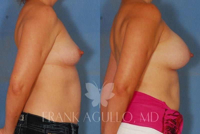 Breast Augmentation Before and After 2