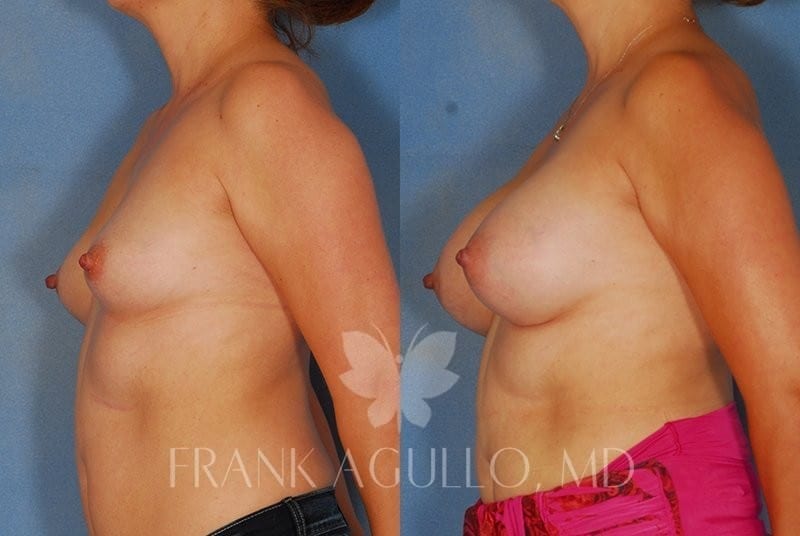 Breast Augmentation Before and After 3
