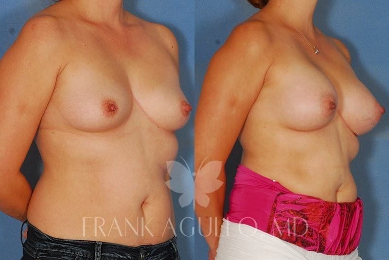 Breast Augmentation Before and After 4